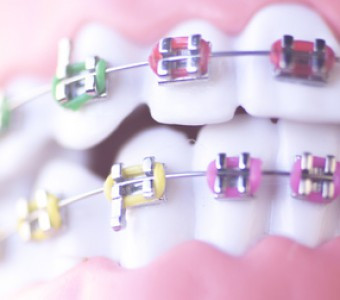 ¿Llevas ortodoncia? Te damos 10 recomendaciones para esta Navidad